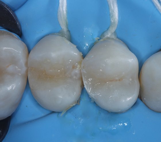 After the placement of universal restorative