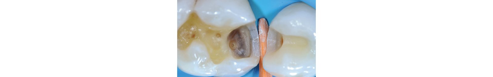 Final prep after removal of amalgam