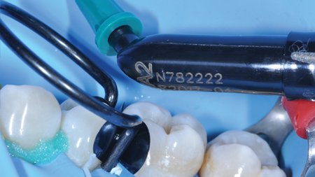 Direct application of Filtek One Bulk Fill Restorative