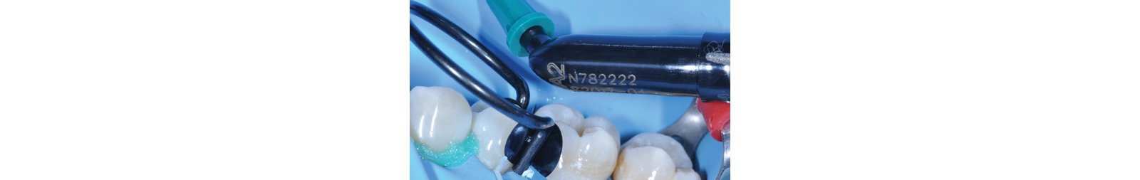 Direct application of Filtek One Bulk Fill Restorative