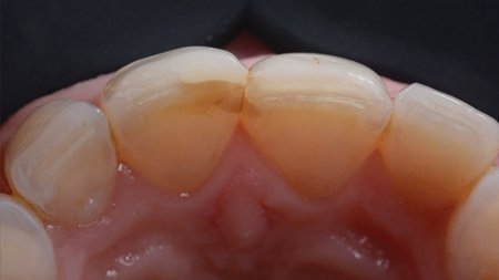 Palatal view of the maxillary anterior teeth