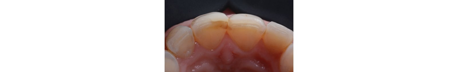 Palatal view of the maxillary anterior teeth