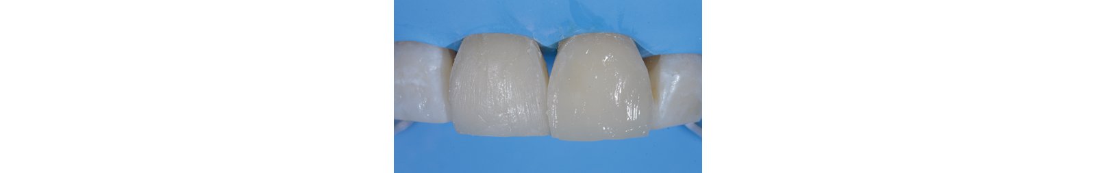 Appearance of the restoration