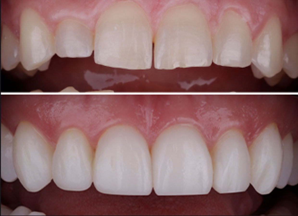 3M™ Filtek™ Matrix Post Orthodontic Before and After Clinical Photos using 3M™ Filtek™ Matrix - JPG File