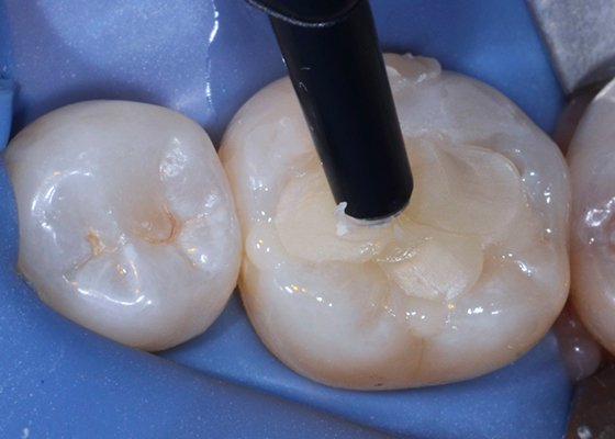 Informative oral care related imagery with a file name of Shear-bond-strength-graph-2-850x400-1.png shown on Solventum's "Brain Floss" blog