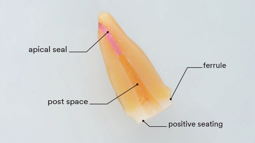 Informative oral care related imagery with a file name of ClinicalCase_27.11.2023_12.png shown on Solventum's "Brain Floss" blog