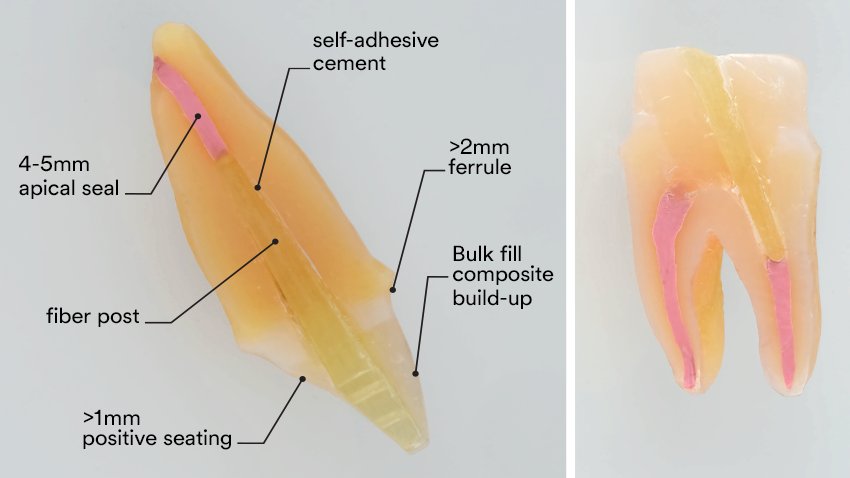 Informative oral care related imagery with a file name of situation-after-extraction.png shown on Solventum's "Brain Floss" blog