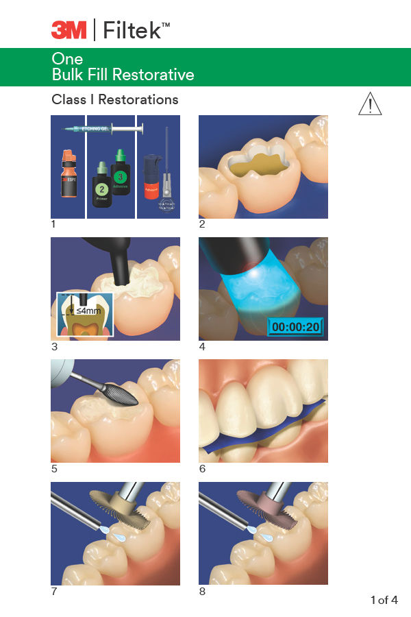 3M™ Filtek™ One Bulk Fill Restorative Class I and II Restorations