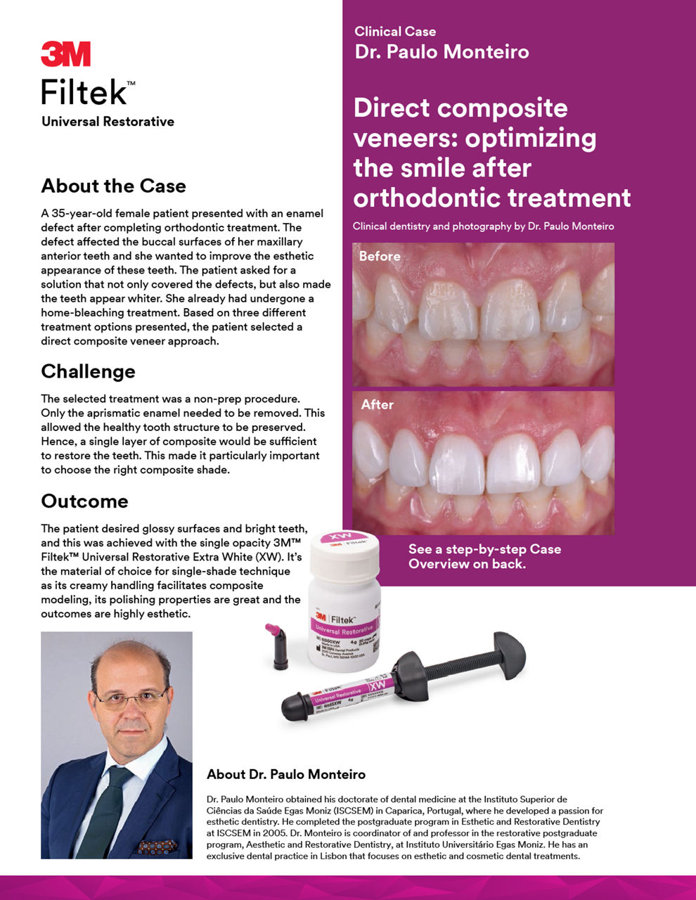 3M™ Filtek™ Universal Restorative Clinical Case Direct Anterior Veneers