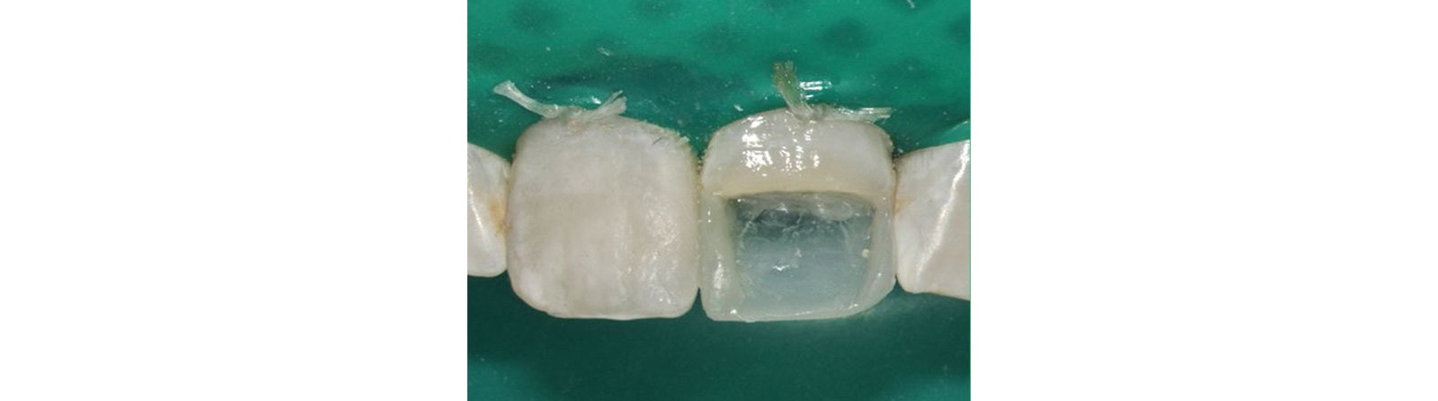 Final proximal surface