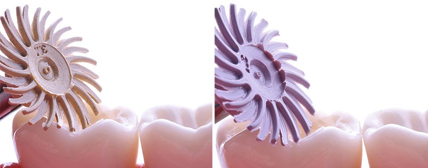 Informative oral care related imagery with a file name of 3MOCSD_Blog_Round13_Arcara_RelyXUniversal_560x460_11.jpg shown on Solventum's "Brain Floss" blog