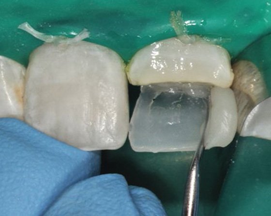 Formed distal contact, then light cured