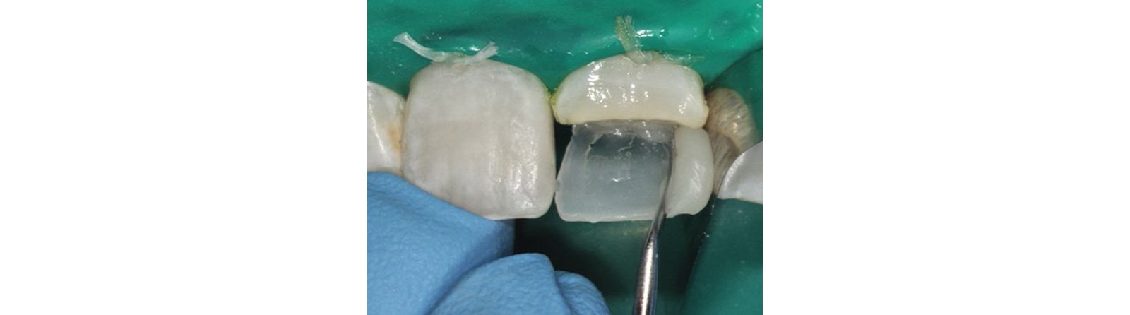 Formed distal contact, then light cured