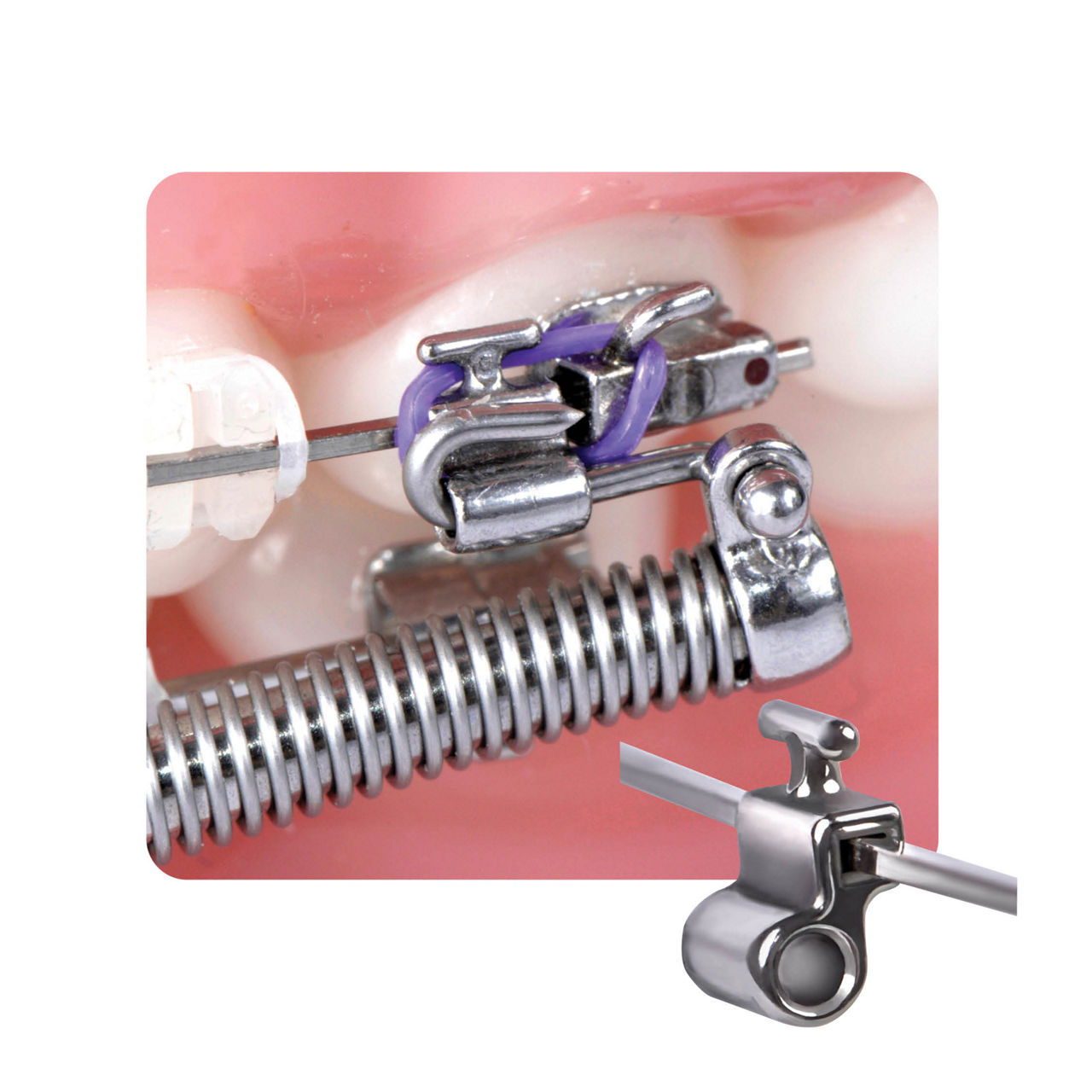 Corretor de Classe II Forsus™ L-Pin