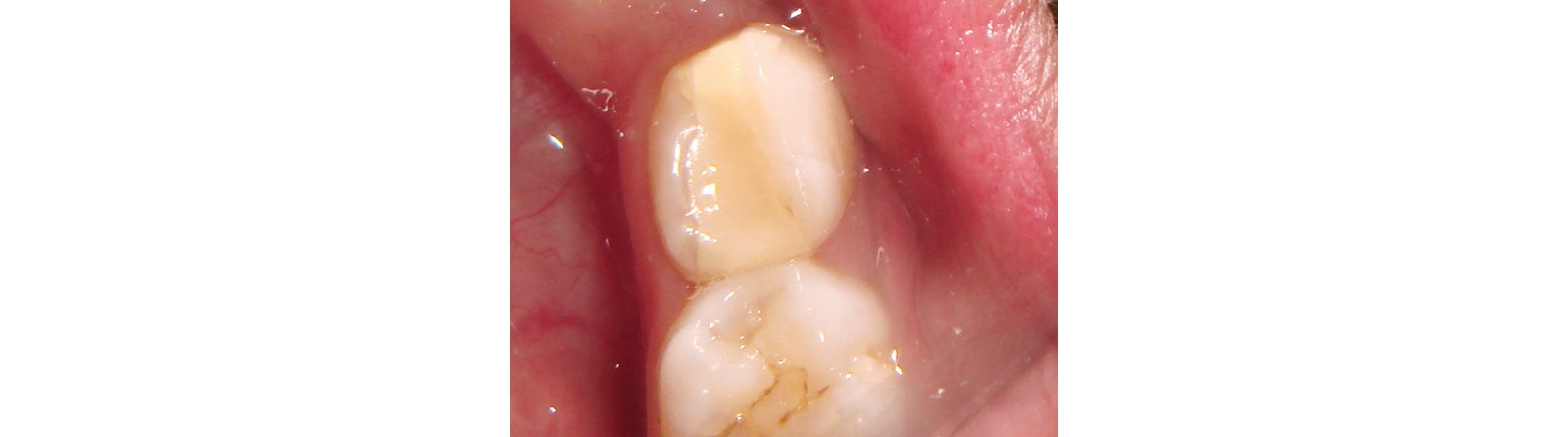 Newly restored tooth