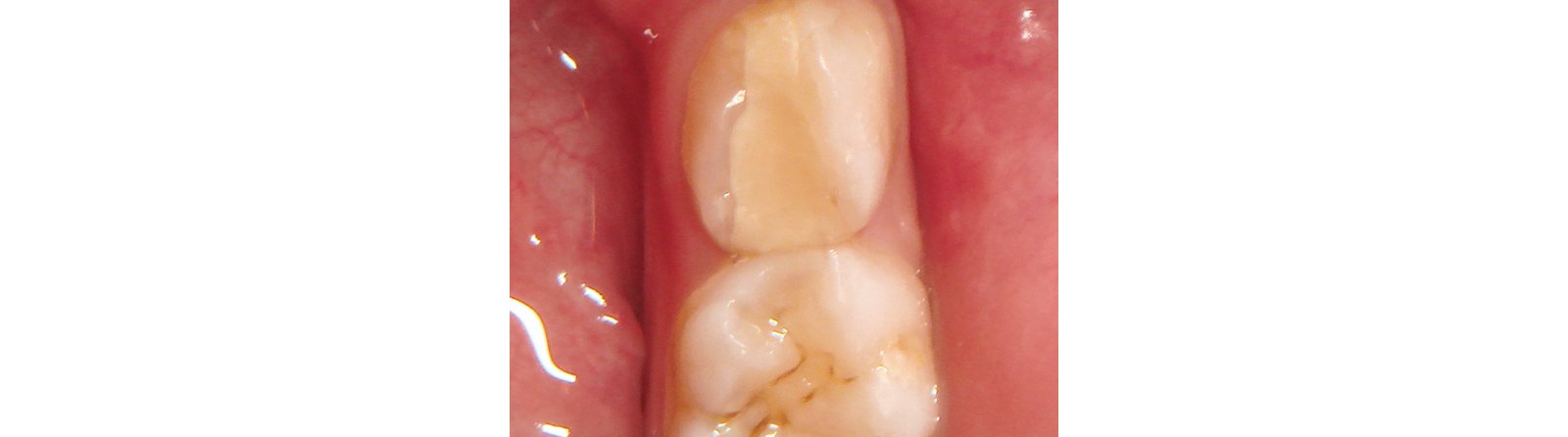 Intact restoration after 12 months