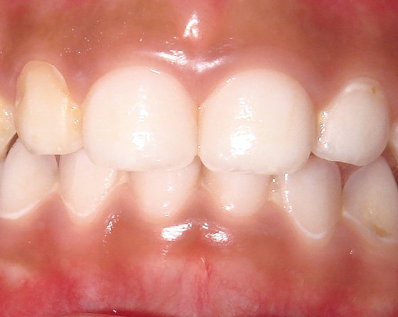 Early enamel lesions