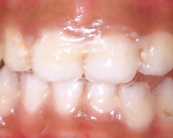 White varnish applied on teeth