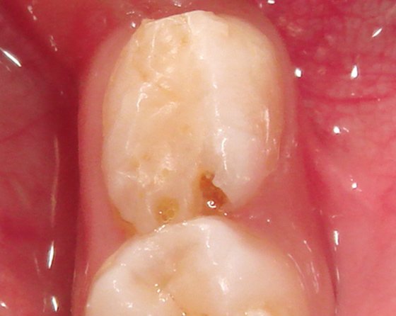 Tooth showed secondary decay