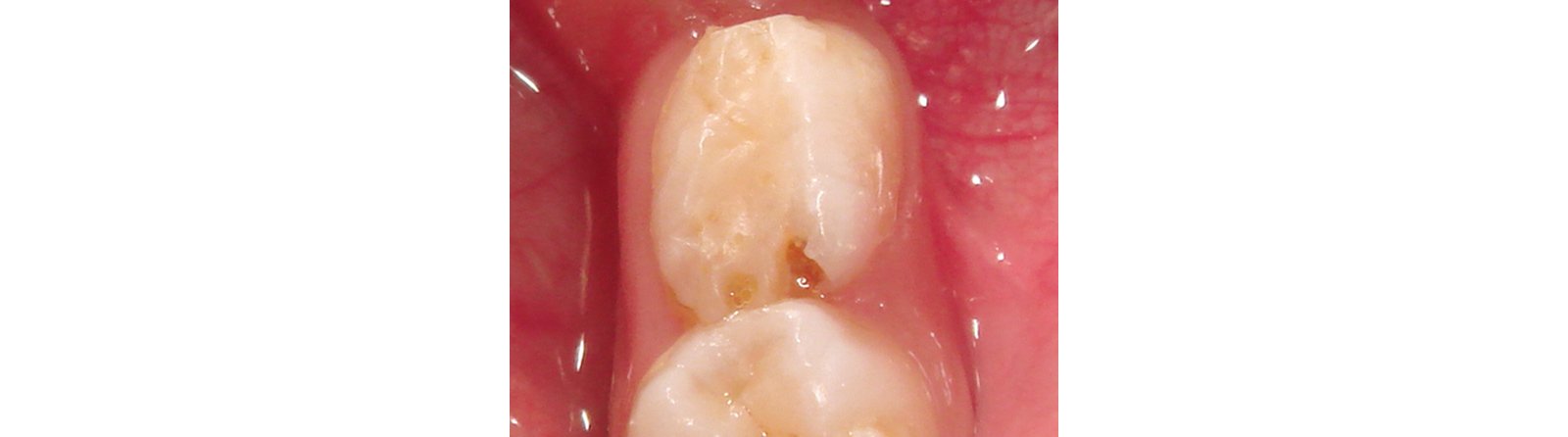 Tooth showed secondary decay