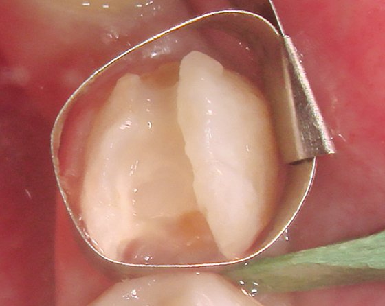 Isolation of the prepared tooth