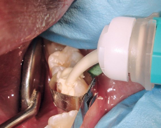 Bulk placement of the glass ionomer restorative