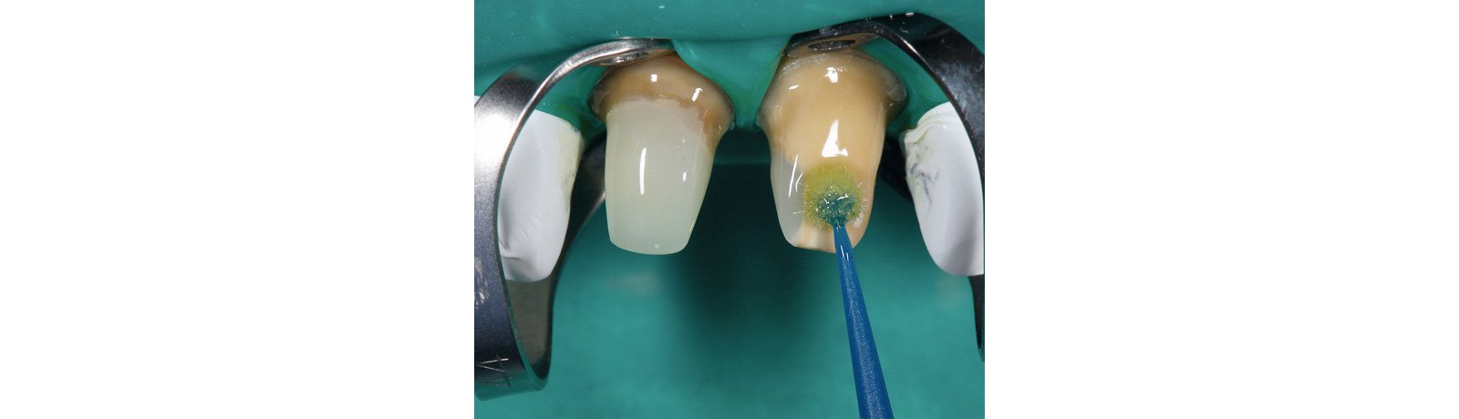 Application of adhesive after application