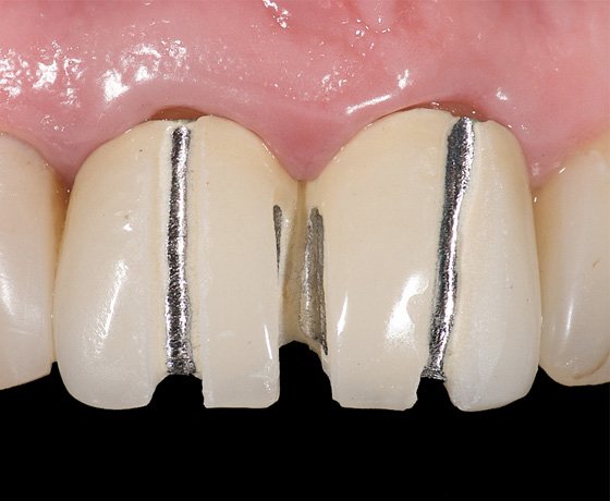 Removal of PFM restorations