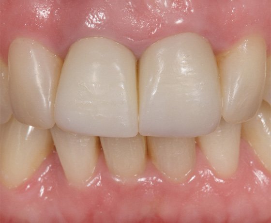 Provisional crowns after eight years in situ