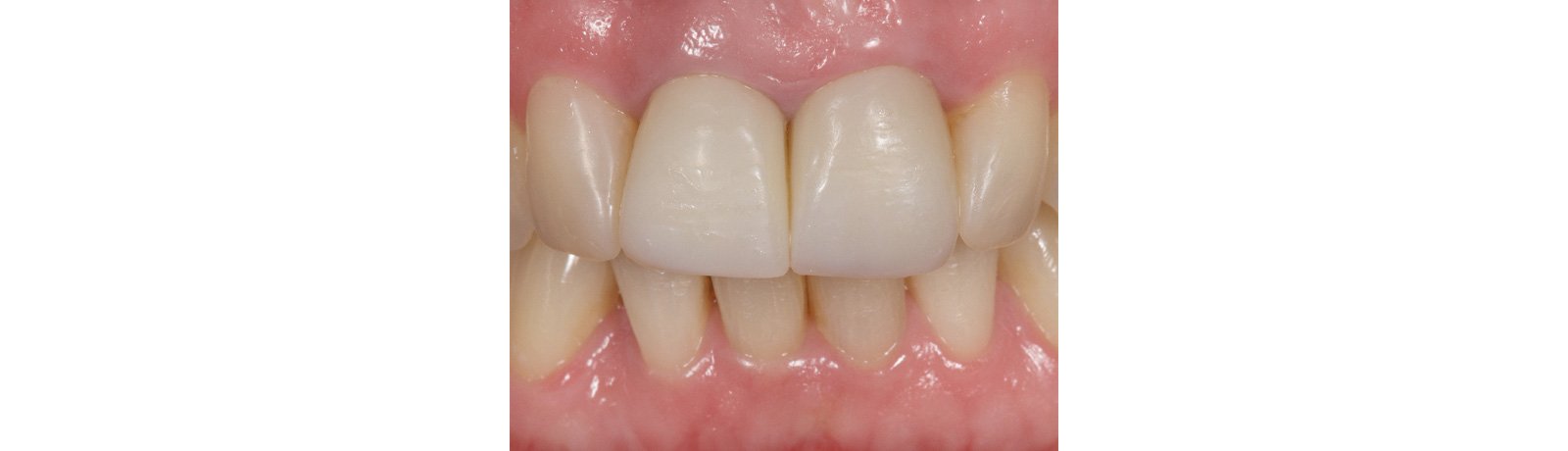Provisional crowns after eight years in situ