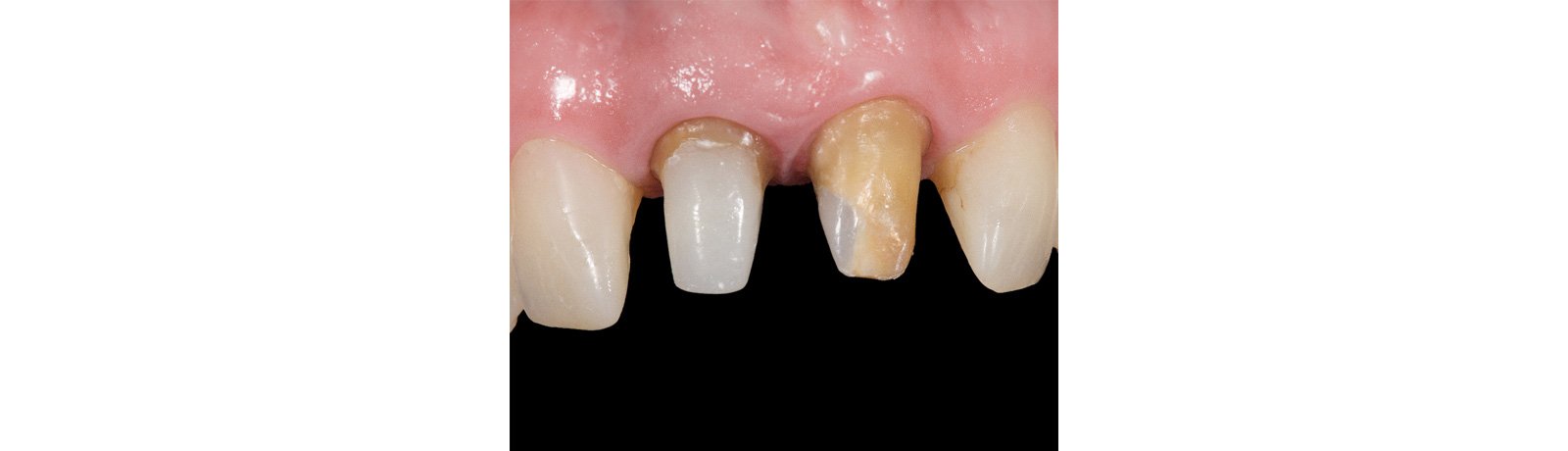 Provisionals removed