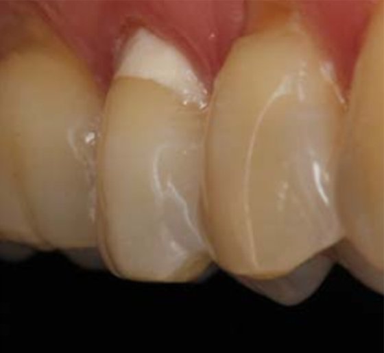 Result obtained immediately after polishing