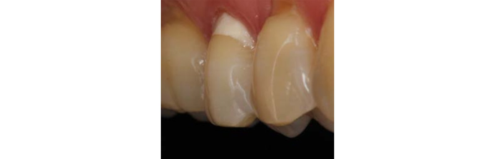 Result obtained immediately after polishing