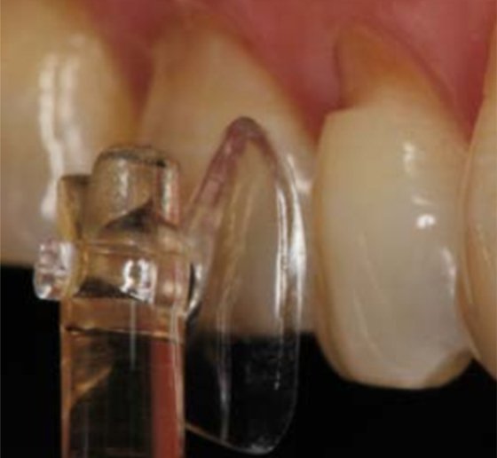 Verification of the size and shape of a cervical matrix