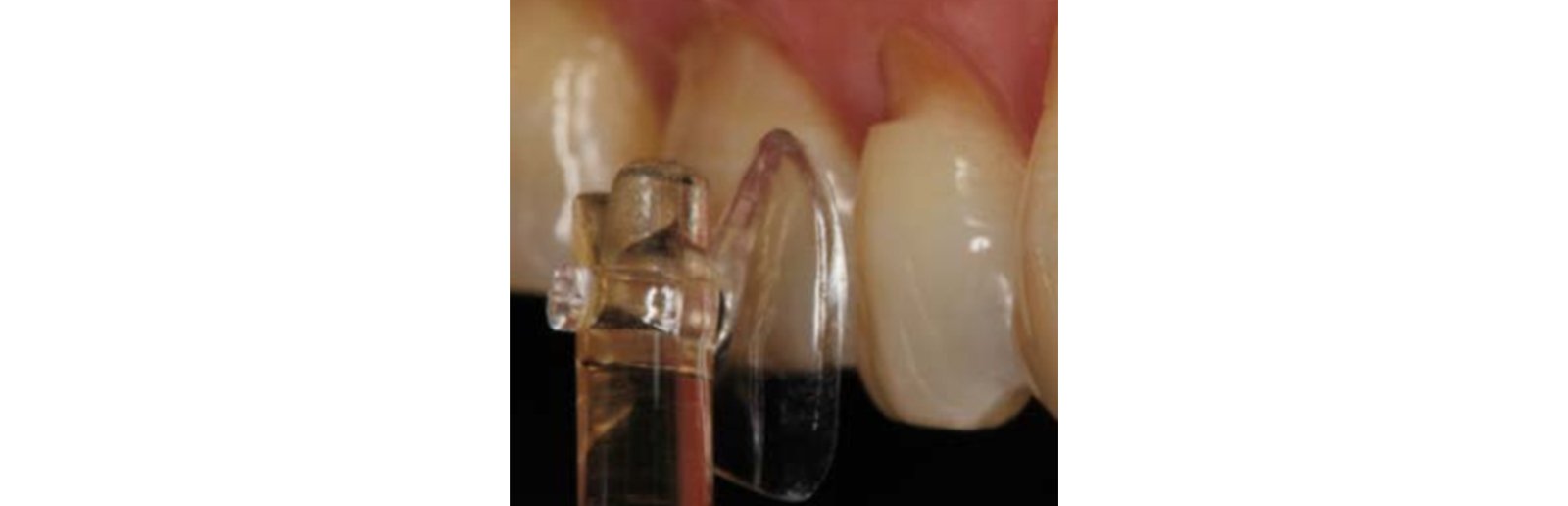 Verification of the size and shape of a cervical matrix