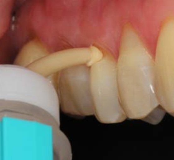 Restorative material is placed directly into the cavity