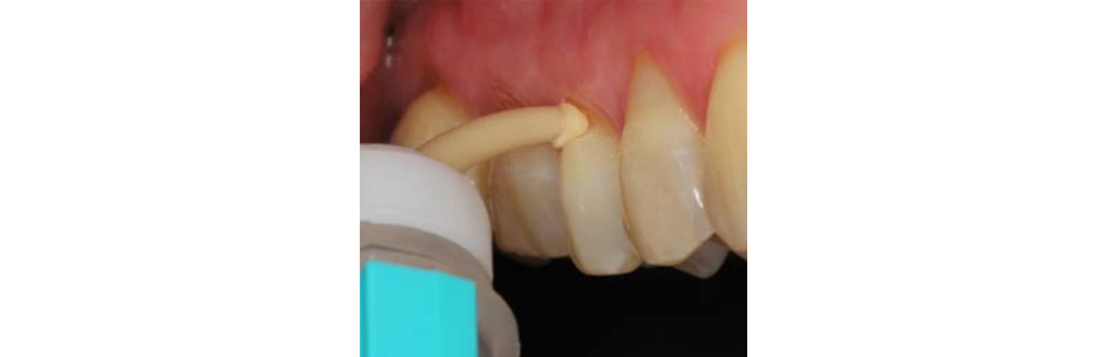 Restorative material is placed directly into the cavity