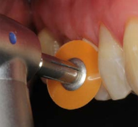 Finishing with contouring and polishing disc
