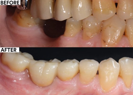 Informative oral care related imagery with a file name of Closing-Anterior-Diastemas-with-Single-Shade-Simplicity_12.png shown on Solventum's "Brain Floss" blog