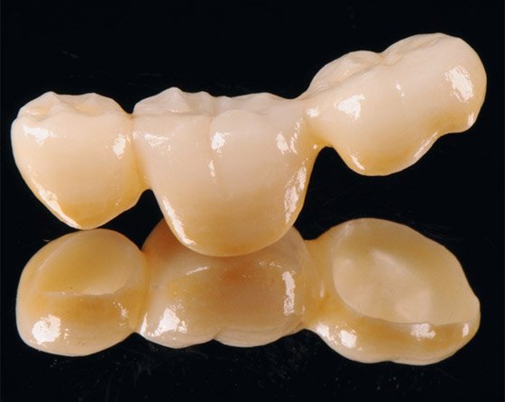 Full-contour zirconia bridge