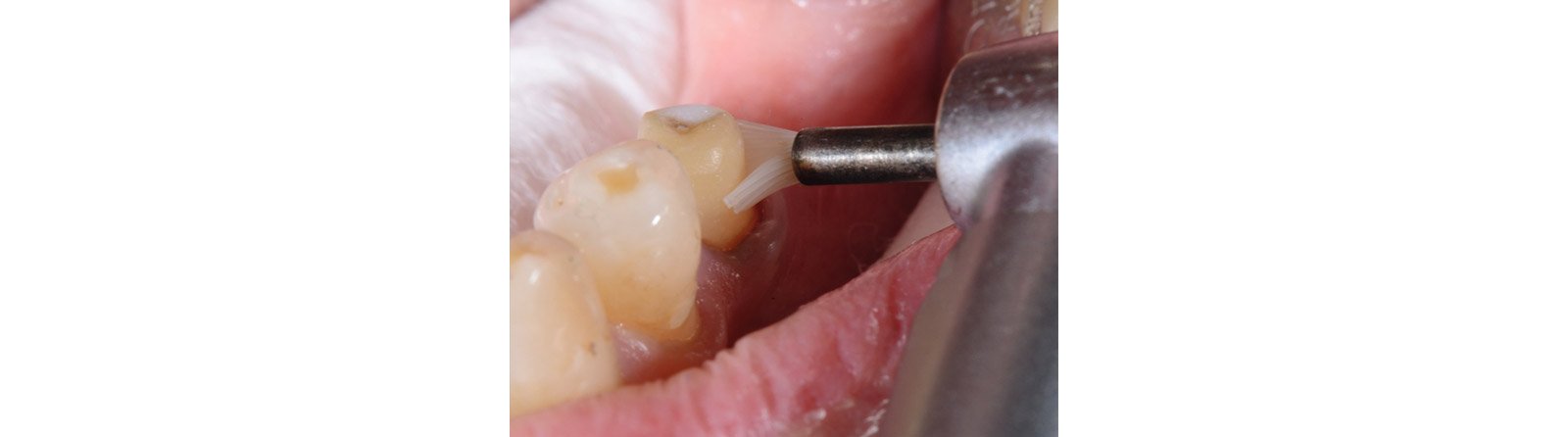 Cleaning of prep with fluoride-free polishing paste
