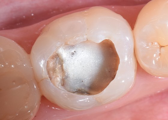 Informative oral care related imagery with a file name of Lateral-Diastema-Closure_3.png shown on Solventum's "Brain Floss" blog