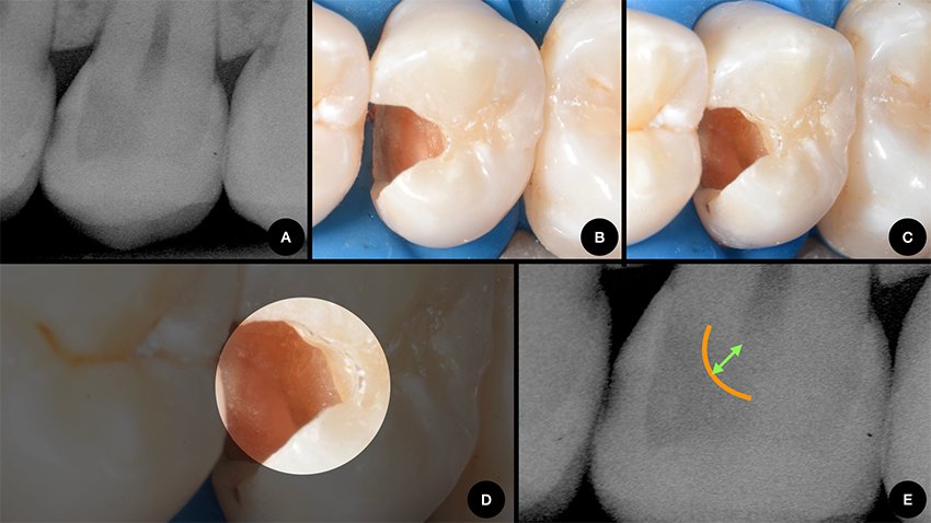 Informative oral care related imagery with a file name of Lateral-Diastema-Closure_4.png shown on Solventum's "Brain Floss" blog