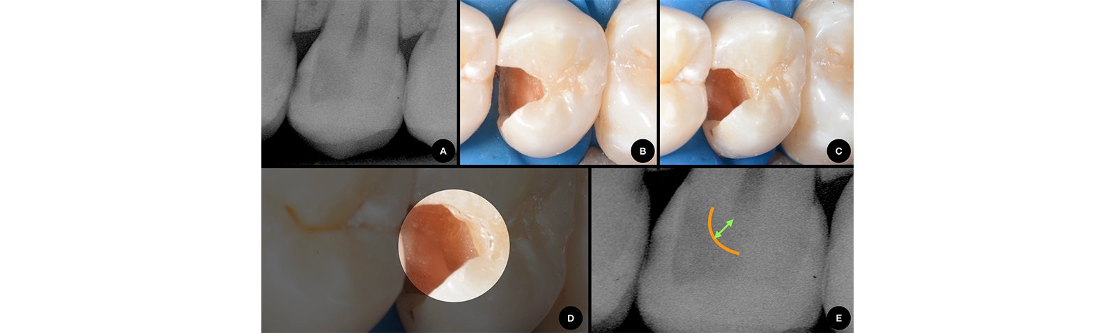 Informative oral care related imagery with a file name of Lateral-Diastema-Closure_4.png shown on Solventum's "Brain Floss" blog