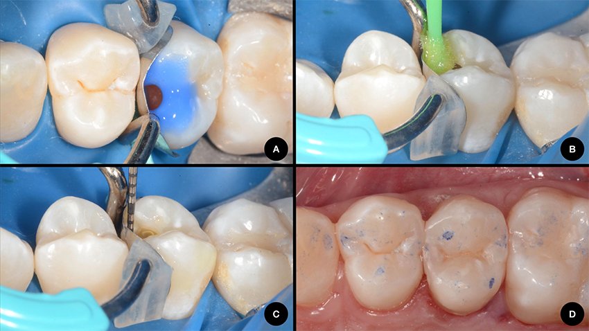 Informative oral care related imagery with a file name of Lateral-Diastema-Closure_5.png shown on Solventum's "Brain Floss" blog