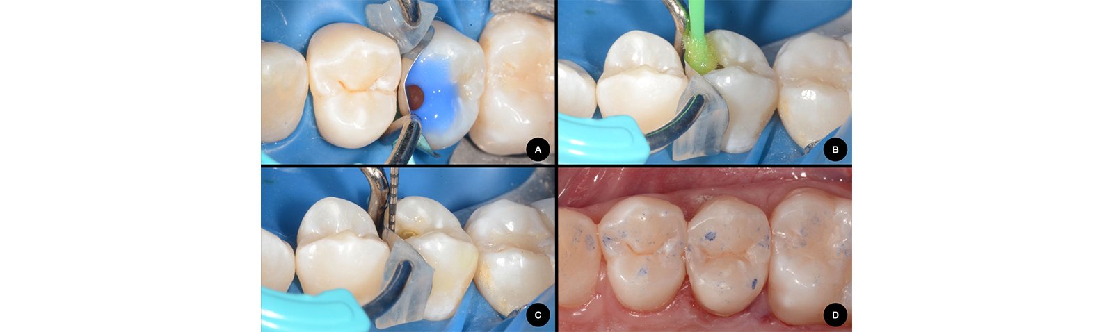 Informative oral care related imagery with a file name of Lateral-Diastema-Closure_5.png shown on Solventum's "Brain Floss" blog