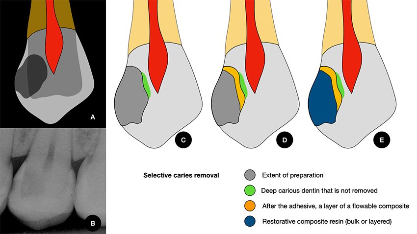 Informative oral care related imagery with a file name of 3MOCSD_Blog_Round13_Robles_Provsional_Permanent_560x460_7.jpg shown on Solventum's "Brain Floss" blog