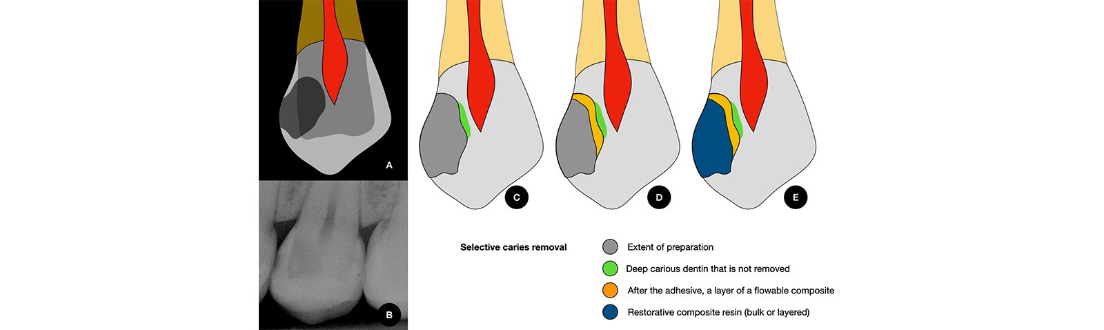 Informative oral care related imagery with a file name of 3MOCSD_Blog_Round13_Robles_Provsional_Permanent_560x460_7.jpg shown on Solventum's "Brain Floss" blog