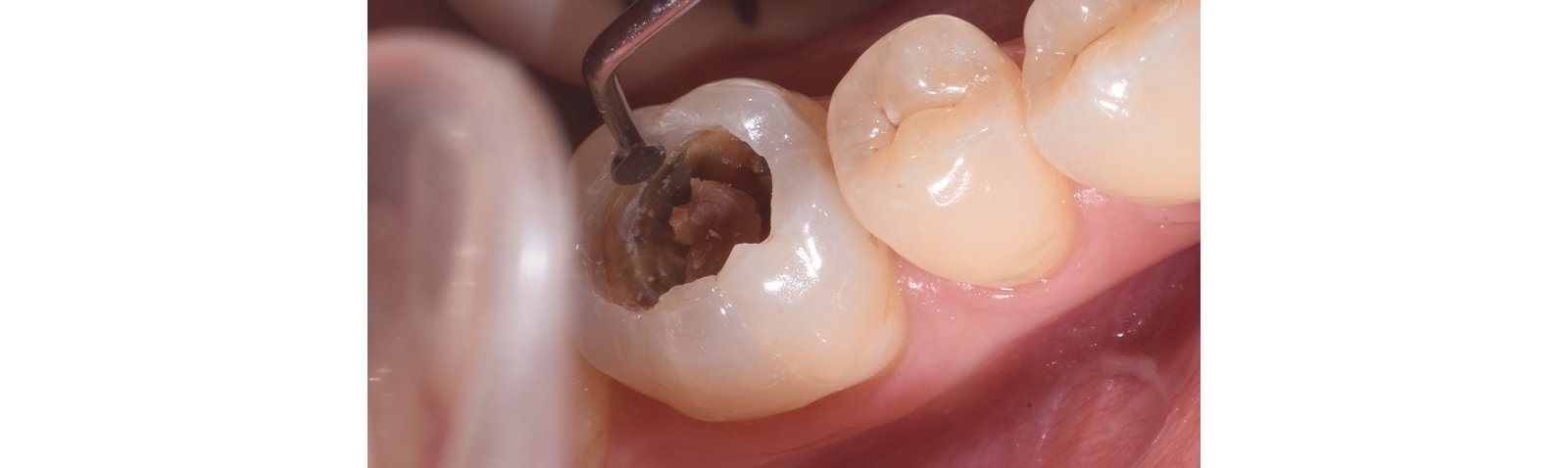 Informative oral care related imagery with a file name of 3MOCSD_Blog_Round13_Robles_Provsional_Permanent_560x460_8.jpg shown on Solventum's "Brain Floss" blog