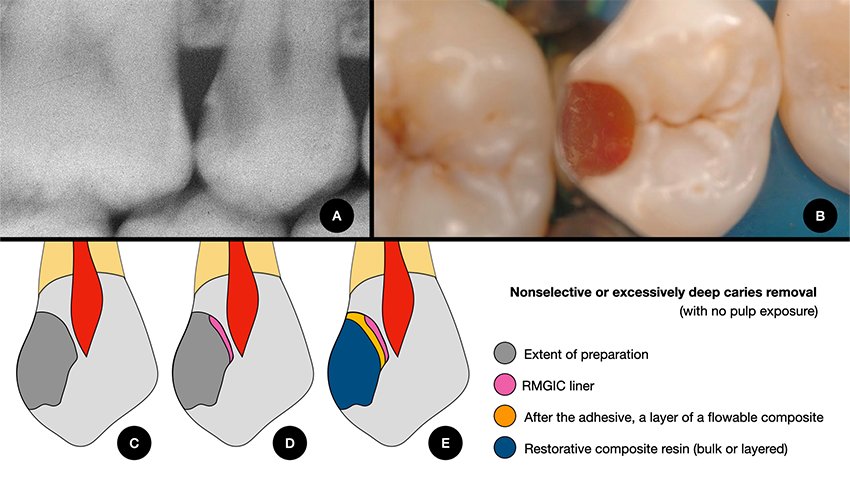 Informative oral care related imagery with a file name of 3MOCSD_Blog_Round13_Robles_Provsional_Permanent_560x460_9.jpg shown on Solventum's "Brain Floss" blog